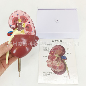 Modelo anatómico de riñón humano, modelo de riñón patológico, especialidad de urología y andrología. - Product Image 4