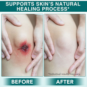 Perban Hidrokoloid ELAIMEI untuk Perawatan Luka, Fleksibel, Tahan Air, Bernapas, Kelas Medis, Perekat Sendiri, Gulungan - Product Image 3