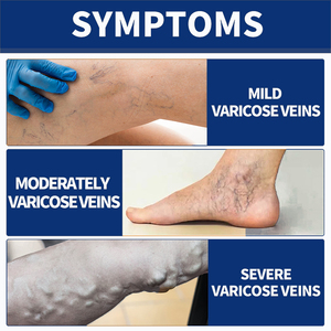 Miao Sanshu, <span class=keywords><strong>crema</strong></span> reparadora de venas del muslo, Gel de compresa fría <span class=keywords><strong>para</strong></span> venas varicosas, OEM, una pieza, venta al por mayor - Product Image 3