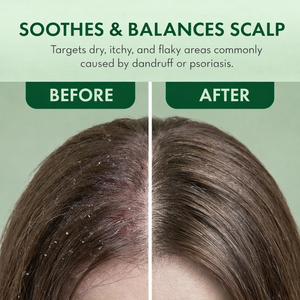 Spray Acondicionador Sin Enjuague de Romero y Menta, Tratamiento Anticaspa para el Cuero Cabelludo con Picazón, Fabricante de Marca Privada OEM - Product Image 5