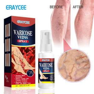 <strong>Best</strong> Sellers Herbal <strong>Varicose</strong> <strong>Vein</strong> Spray Treat Vasculitis Phlebitis Pain Relief <strong>Cream</strong> Spots OEM ODM - Product Image 2