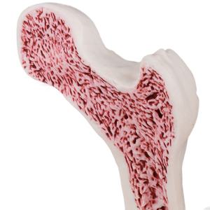 Osteoporose modell für die Medizin 4-stufige Degeneration Lendenwirbel kompression faktur für die Ausbildung von Ärzten im Klassen zimmer in Biologie - Product Image 6