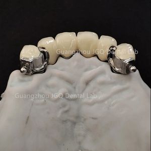 Dentaduras postizas totalmente cerámicas Zirconia o dentaduras postizas Pfm Tipos de Diseño Digital en <span class=keywords><strong>Exocad</strong></span> Rápido y eficiente - Product Image 6