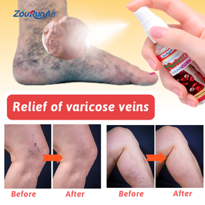 Spray <span class=keywords><strong>para</strong></span> el Cuidado de <span class=keywords><strong>las</strong></span> Venas Varicosas ZouRunAn 30ml, Masaje de Piernas, Circulación, Bienestar Externo, Alivio del Dolor, Alcanfor - Product Image 3