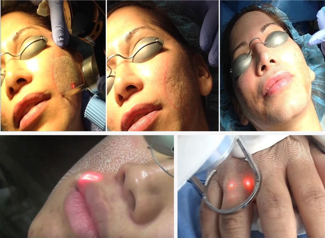Skin CO2 Fractional Laser Resurfacing Treatment Machine Price