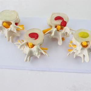 Lesione della colonna lombare a quattro stadi modello anatomico per l'educazione medica - Product Image 4