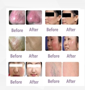 980nm Diodelaser Machine Voor Vasculaire Laesies En Haarverwijdering-Professionele Kwaliteit - Product Image 6