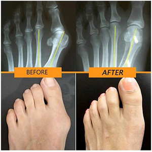 Бесплатный образец ухода за ногами при вальгусной деформации, облегчение боли, коррекция бурсита, шина, корректор бурсита - Product Image 4