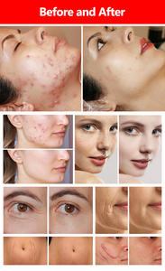 Máquina de Belleza con Láser Fraccional de CO2 para Clínicas Dermatológicas que Ofrece Beneficios de Eliminación de Cicatrices, Reafirmación de la Piel y Antienvejecimiento - Product Image 6