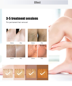 Laser Diodo Portatil Épilation Épilation 1200W 1600W Portable 755 808 1064 Diode Laser Épilation - Product Image 6