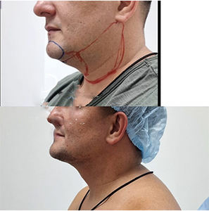 بسعر المصنع 1470 نانومتر 980 نانومتر ديود معدات الليزر إندوليزر الليزر تحلل الدهون جهاز شفط الدهون وفقدان الوزن - Product Image 5