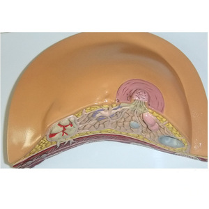 نموذج سرطان الثدي الأنثوي بالحجم الطبيعي نموذج فحص الثدي المرضي للإناث نماذج تشريحية للتعليم الطبي - Product Image 5