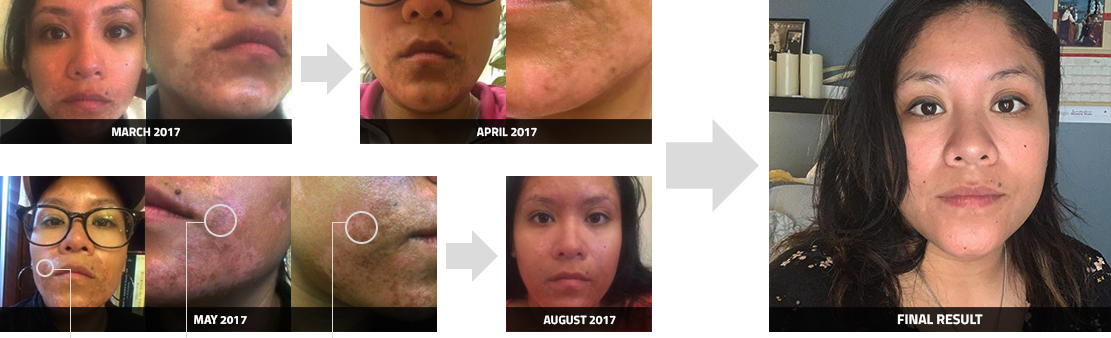 uvb test lamp scalp psoriasis treatment 311nm Uvb Lamp