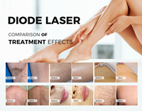 Offre Spéciale : Appareil Professionnel d'Épilation Laser Diode 1800W 4K Triple Onde 755 808 1064nm – Prix Compétitif