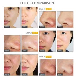 Da sử<span class=keywords><strong>a</strong></span> chữ<span class=keywords><strong>a</strong></span> nếp nhăn Phun Chân không tần số cao sóng âm thanh dermabrasion siêu âm da lột bàn chải da chết loại bỏ sinh học - Product Image 5