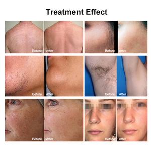 جهاز إزالة الشعر بليزر ديود عمودي W للمنزل والصالون يستخدم 3 أطوال موجية أداة تجميل قدرة بشرة لطيفة - Product Image 4