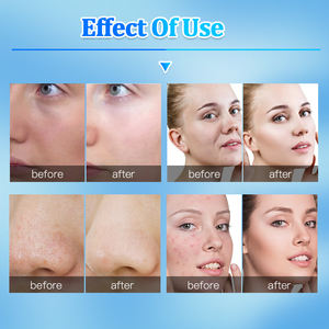 Beste Salon 4 In 1 Gezichtsbehandeling Zuurstofconcentrator Huid Scrubber Hydro Dermabrasie Oxgeen Gezichtsmachine - Product Image 6