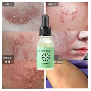 Serum perawatan kulit penghilang jerawat, perawatan kulit ular venom peptida Serum solusi Anti jerawat tanda jerawat - Product Image 2