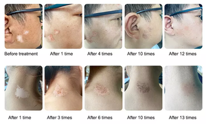 4003 terapi cahaya Uvb Kernel paling efektif, lampu UVB 311nm pita sempit perangkat fototerapi UV untuk perawatan Psoriasis Vitiligo - Product Image 3