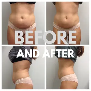 جهاز شفط الدهون بالليزر 980 نانومتر 1470 نانومتر جهاز تجميل وإزالة الدهون من ورم الدهون بالليزر جهاز تنعيم للوجه لشفط الدهون جراحية جهاز إندولازير - Product Image 5