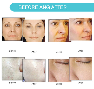 Hydra Pen H2 Profesional, Dermapen Eléctrico, Microagujas, Infusión de Suero, Equipo de Belleza para Reafirmar la Piel - Product Image 5