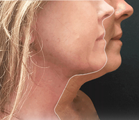 Machine de liposuccion au laser Vaser, lifting endolaser du visage, laser diode professionnel 980 nm 1470 nm
