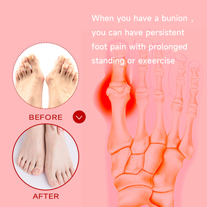 8 unids/caja parche de corrección de pulgar ajustador Corrector de dedo gordo del pie parche Hallux Valgus en la articulación Hallux - Product Image 5