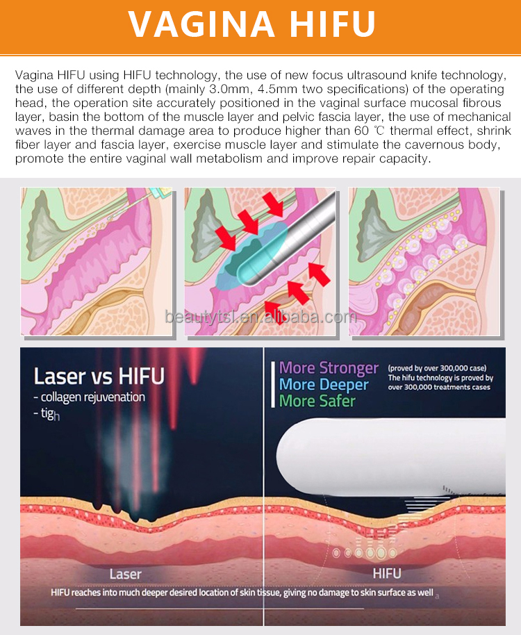 HIFU-Maschine zur Vaginalverjüngung, tragbare Vaginalstraffungsmaschine, HIFU/Vaginastraffungsmaschine