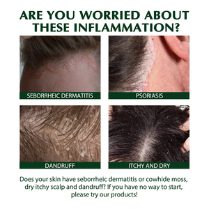 <span class=keywords><strong>Shampooing</strong></span> capillaire anti-démangeaisons pour le <span class=keywords><strong>psoriasis</strong></span>, la dermatite séborrhéique, le teigne, la séborrhéo-démangeaisons, marque privée - Product Image 4