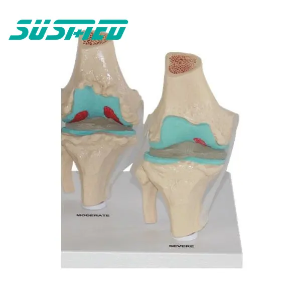 घुटने संयुक्त रोग मॉडल 4 चरण के लिए संरचनात्मक मॉडल शरीर रचना विज्ञान शिक्षण