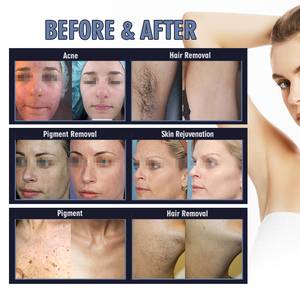 Nouvelle arrivée 2026, machine professionnelle d'épilation permanente IPL, épilation au laser DPL pour salon - Product Image 5
