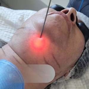 Appareil de beauté portable Endolifting 1470nm+980nm Laserlift, laser diode, lipolyse par fibre, réduction de la graisse, pour le visage et les paupières inférieures - Product Image 5