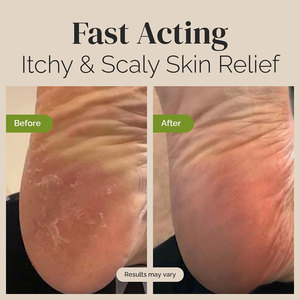 Bálsamo Antifúngico Natural con Árbol de Té y Extractos Herbales |   Crema Corporal, Alivio para el Pie de Atleta, la Picazón Deportiva y el Tiña |   Anti-picazón - Product Image 5