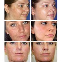 VOVA-Gel hydratant anti-acné, éclaircissant, correcteur de peau, taches foncées, Melasma, crème de Pigmentation, lotion hydratante