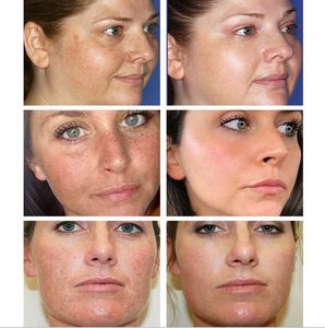 <span class=keywords><strong>VOVA</strong></span>-crema correctora de la piel, Gel hidratante de pigmentación para el punto oscuro, Melasma, eliminación del acné, Blanqueador - Product Image 4