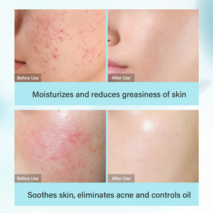 Tea Tree Ácido salicílico Cuidado DE LA PIEL coreano Crema para eliminar el acné Facial Anti Acné Juego DE CUIDADO DE LA PIEL antienvejecimiento - Product Image 6