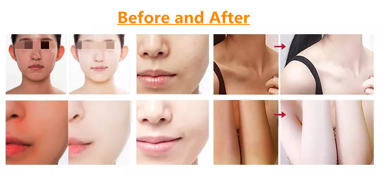 1800w Skin Rejuvenation Machine