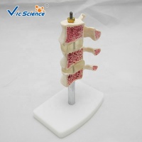 Modelo Anatómico Comparativo de Patología de Columna Vertebral, Modelo de Lesión de Vértebras Lumbares para Enseñanza de Ortopedia, CE/ISO/ROHS/CNAS