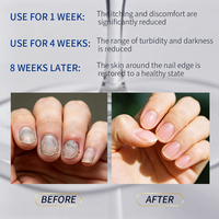 Traitement antifongique des ongles sous marque privée, sérum liquide pour soins des ongles, solution réparatrice pour onychomycose des ongles d'orteils, vente en gros OEM