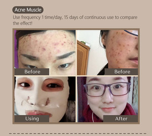 Bùn tấm mặt nạ Vá tốt nhất sâu lỗ chân lông làm sạch điều trị Mặt nạ đất sét cho mặt nạ trên khuôn mặt - Product Image 2