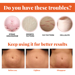 Huile <span class=keywords><strong>anti</strong></span>-vergetures en marque blanche en gros, sérum réparateur de cicatrices pour le traitement des vergetures post-partum - Product Image 3