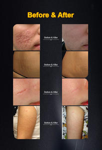 Verticale gynaecologische esthetische CO2-machine met 360° °   Behandelkop voor nauwkeurige rimpelverwijdering en huidversteviging - Product Image 6