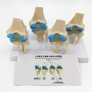 Modelo esquelético patológico de articulación de rodilla en cuatro partes; modelo de articulación de rodilla patológica/con lesiones; articulación degenerativa. - Product Image 4
