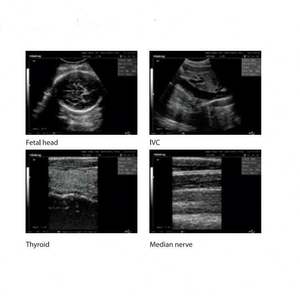 DP-2200 Ultraschall-Diagnosegerät Ultraschallscanner OB-Messung - Product Image 4