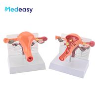 Modelo de anatomía del útero y ovario femenino Medeasy, modelo de útero normal y con enfermedades, con base desmontable para la enseñanza de enfermería médica