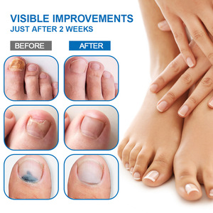 Sumifun New Bright Foot para la Serie Kit, Ungüento Antihongos para el Cuidado de la Onicomicosis, 2 Años de Duración, Suministro de <span class=keywords><strong>Amazon</strong></span> - Product Image 2
