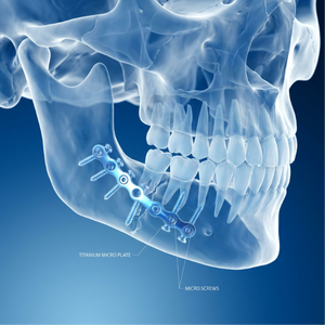 Micro-implants en titane de haute précision usinés en Suisse pour la chirurgie maxillo-faciale - Product Image 2