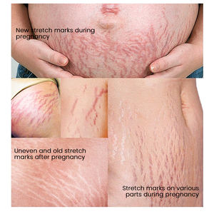 Minyak <span class=keywords><strong>Bio</strong></span> MULAN untuk Stretch Mark, Losion Penghilang Stretch Mark, Melembapkan, Menutrisi, Memperbaiki, Minyak Stretch Mark - Product Image 2