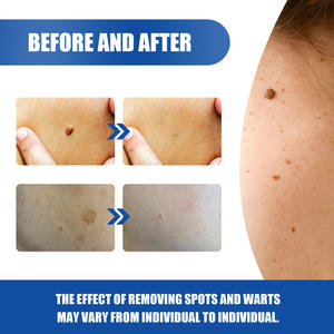 Suero para eliminar <span class=keywords><strong>verrugas</strong></span> de la piel, <span class=keywords><strong>crema</strong></span> reparadora de la piel, removedor de <span class=keywords><strong>verrugas</strong></span>, removedor de <span class=keywords><strong>verrugas</strong></span> <span class=keywords><strong>genitales</strong></span> para hombres - Product Image 3