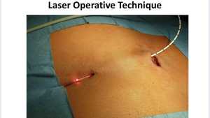 Diodo láser cirugía 980nm hemorroides pilas buasir hemorroides fístula láser ablación proctología láser - Product Image 3